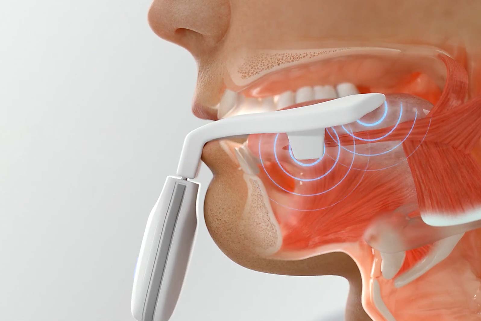 Transoral awake state neuromuscular electrical stimulation therapy for mild  obstructive sleep apnea