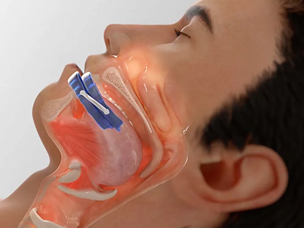 Nighttime Therapy for Snoring & For Sleep Apnea Device Diagram